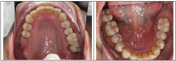 PSR case 4